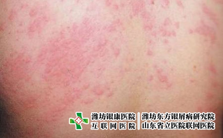 接触性皮炎该怎么预防?