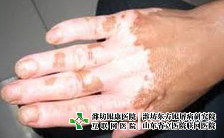 节段型白斑在潍坊白癜风医院该怎么治?