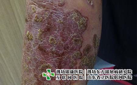 银屑病为什么会发生