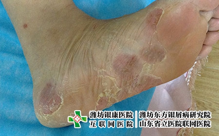 湿疹的病发原因都有什么 湿疹的病发原因都有什么