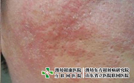过敏性皮炎早期预防方法?