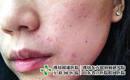 接触性皮炎的常见症状主要是什么呢
