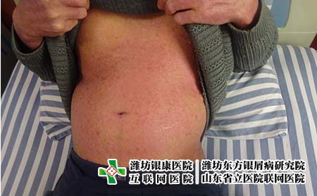 生活哪些因素导致了牛皮癣二次复发 生活哪些因素导致了牛皮癣二次复发