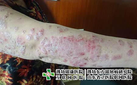 得了牛皮癣应该怎么做才正确