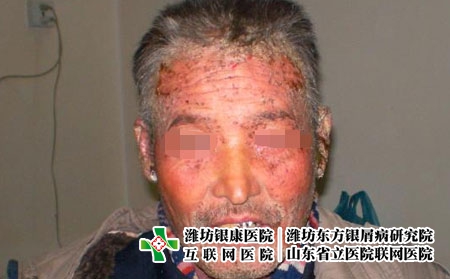 头上牛皮癣疾病表现有哪些