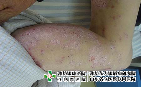 银屑病患者如何护理才好 银屑病患者如何护理才好