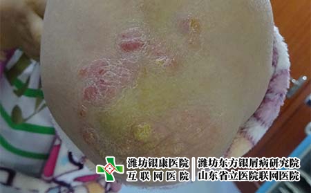 银屑病患者应该避免的误区 银屑病患者应该避免的误区