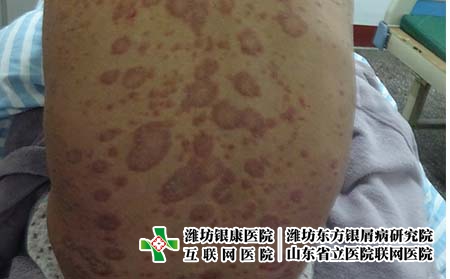 牛皮癣应该怎样预防 牛皮癣应该怎样预防