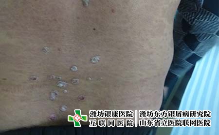 牛皮癣患者如何培养健康合理的饮食习惯 牛皮癣患者如何培养健康合理的饮食习惯