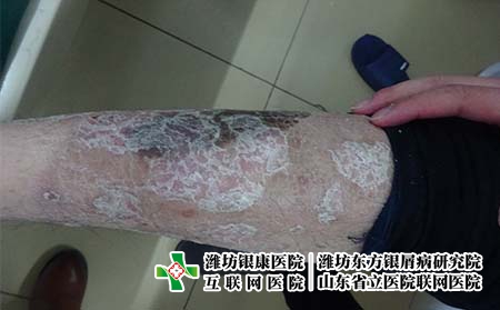 牛皮癣早期的症状有哪些 牛皮癣早期的症状有哪些