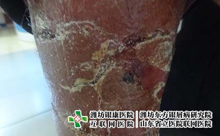 有牛皮癣具体要怎么控制