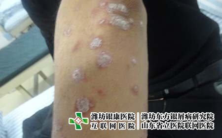 银屑病是因为什么原因引起的