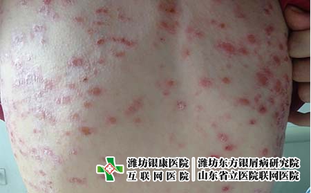牛皮癣是什么原因引起的