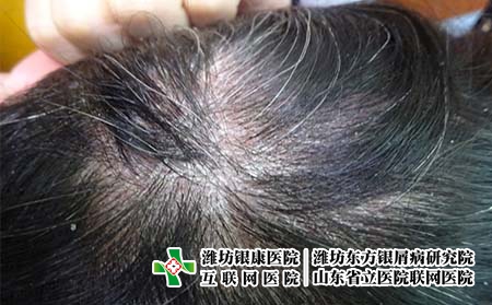 潍坊哪里治银屑病好