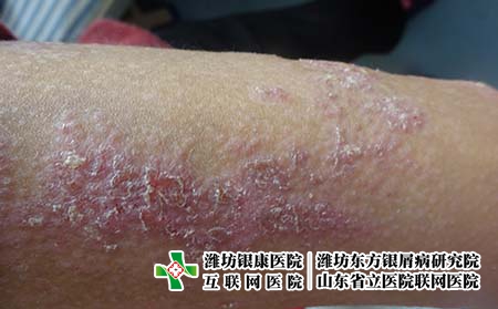 么牛皮癣有哪些初期症状 么牛皮癣有哪些初期症状