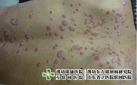 银屑病的常见症状表现是什么?