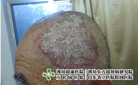 哪些因素导致牛皮癣的发生呢