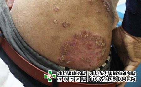 得了牛皮癣的症状表现是哪些呢?