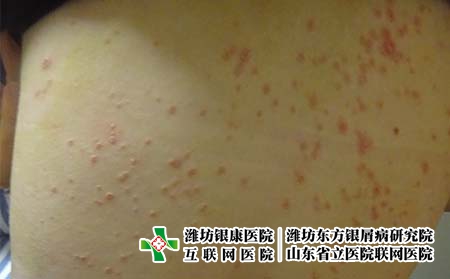 牛皮癣患者怎么才能控制住病情的发展呢