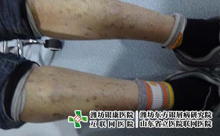怎样可以预防牛皮癣