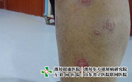 牛皮癣是不是会传染?