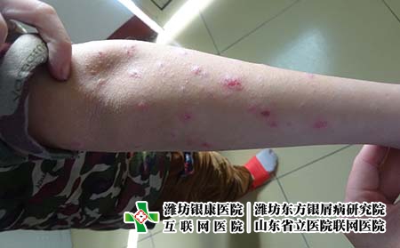 牛皮癣会不会遗传给孩子呢