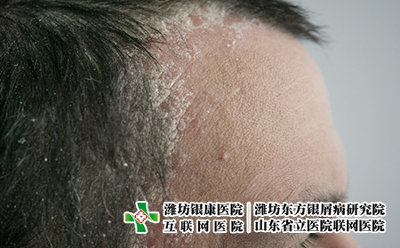 头皮牛皮癣2