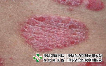 斑块状银屑病2