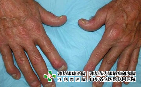 银屑病关节炎2