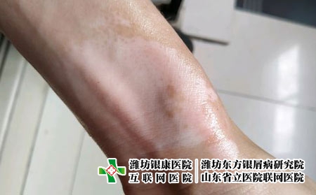 白癜风 (21) 白癜风 (21)