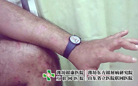 银屑病关节炎3 银屑病关节炎3
