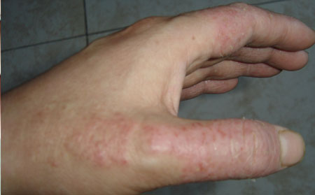 手足癣注意问题