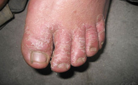 脚气发作怎么办