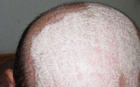 头癣会变成秃头吗?