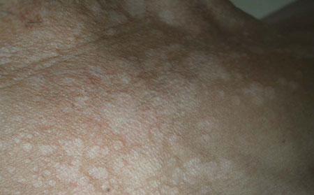 汗斑癣会传染吗