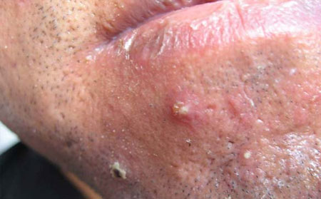 毛囊炎的治疗方法