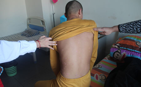 治疗复发的皮肤病