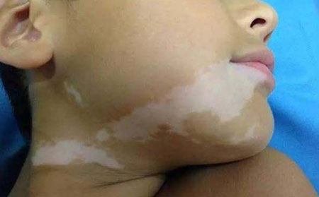潍坊哪里治白癜风