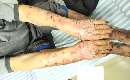 皮肤瘙痒如何治疗