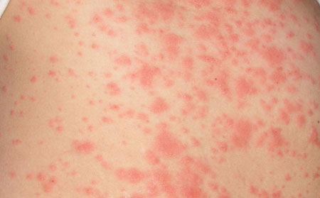 皮肤瘙痒症状表现有哪些