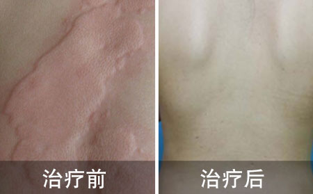 荨麻疹治疗