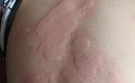 潍坊治过敏哪个医院治疗好过敏怎么回事