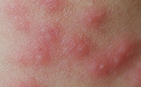 潍坊治皮肤瘙痒医院哪家好皮肤瘙痒怎么办