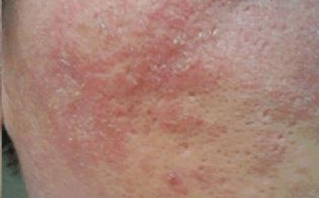 潍坊哪里治疗皮炎面部皮炎总反复