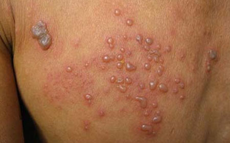 潍坊治带状疱疹,潍坊哪里治带状疱疹