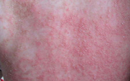 宝宝湿疹治疗,夏季湿疹治疗