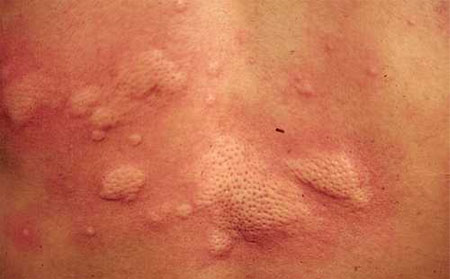 夏季荨麻疹病因,夏季为什么患荨麻疹