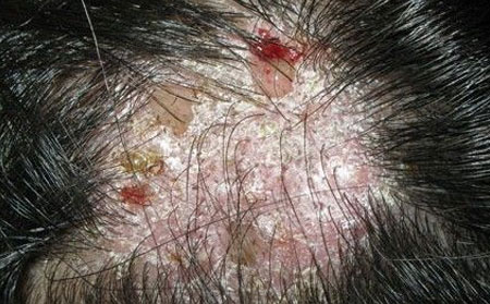 儿童头癣治疗,怎样治疗儿童头癣