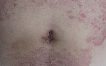 体癣怎样治疗,有体癣怎么办