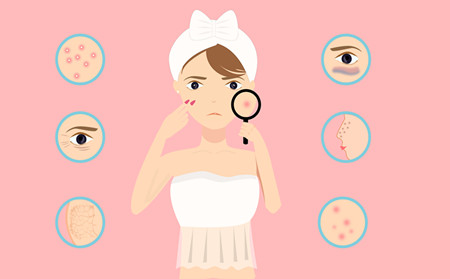 夏季痤疮加重,夏季长痤疮